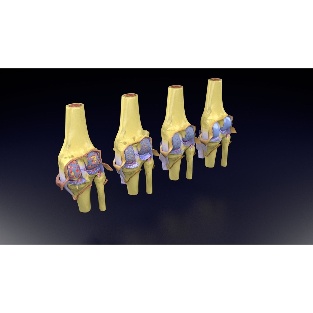 Osteoarthritis 3D Model – Medical Anatomy with Detailed Staging - View 62