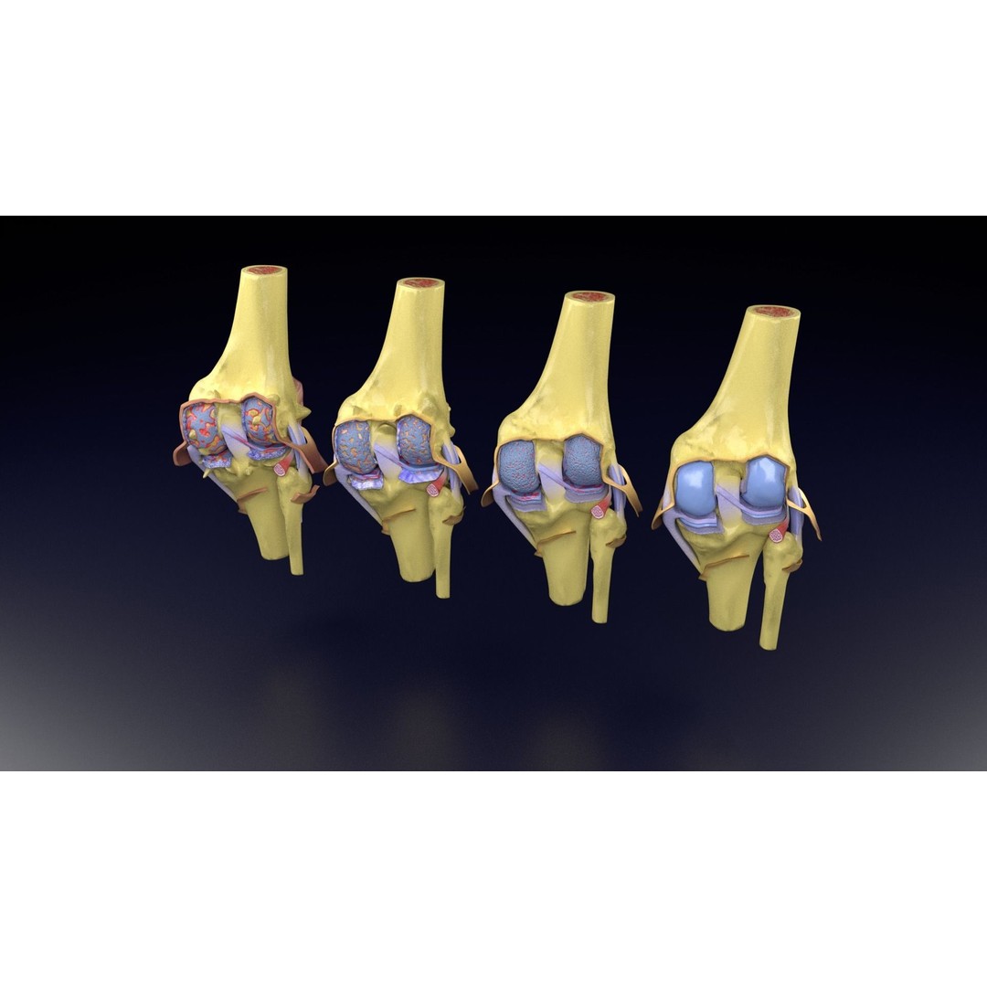 Osteoarthritis 3D Model – Medical Anatomy with Detailed Staging - View 63