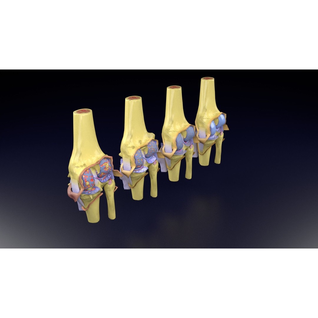 Osteoarthritis 3D Model – Medical Anatomy with Detailed Staging - View 64