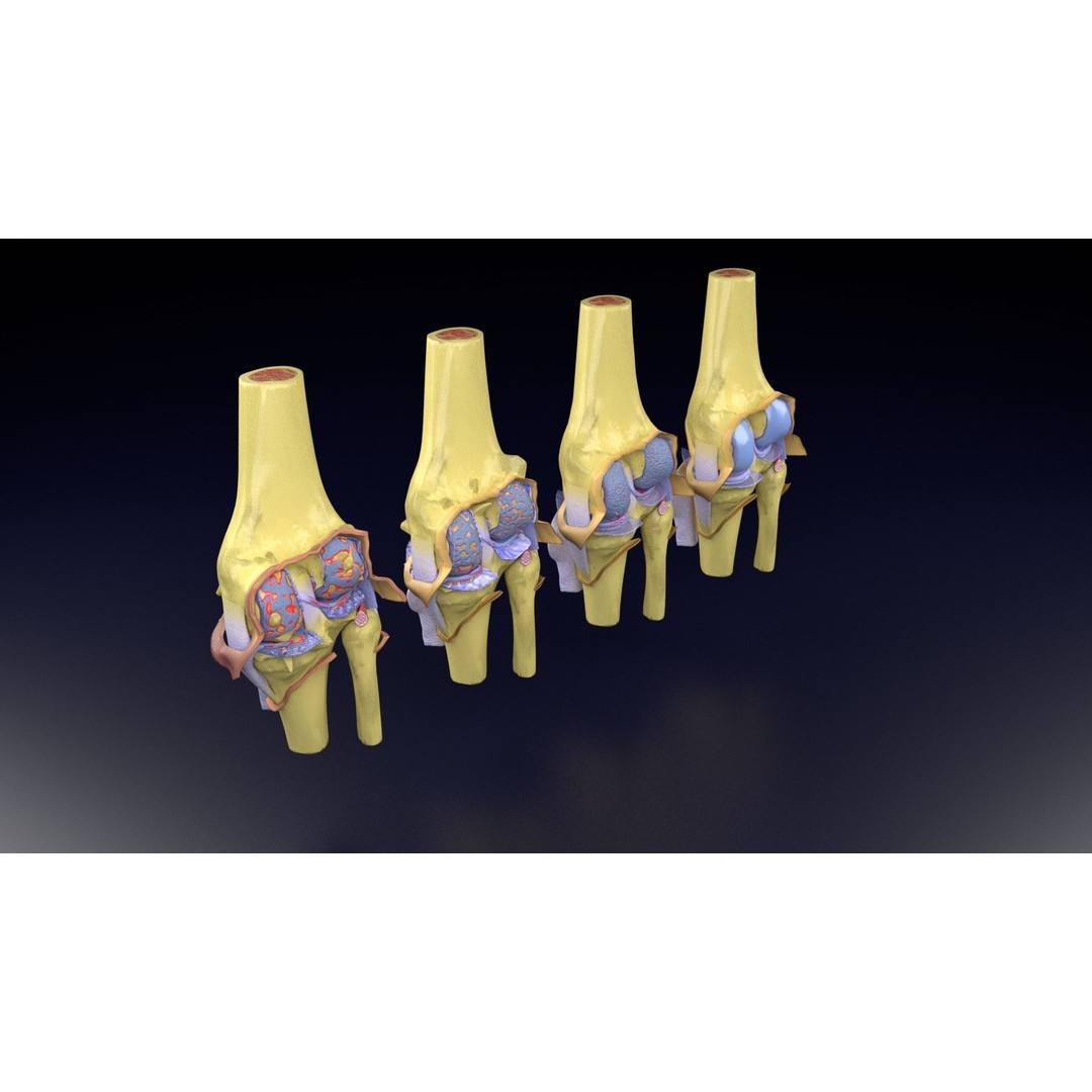 Osteoarthritis 3D Model – Medical Anatomy with Detailed Staging - View 65