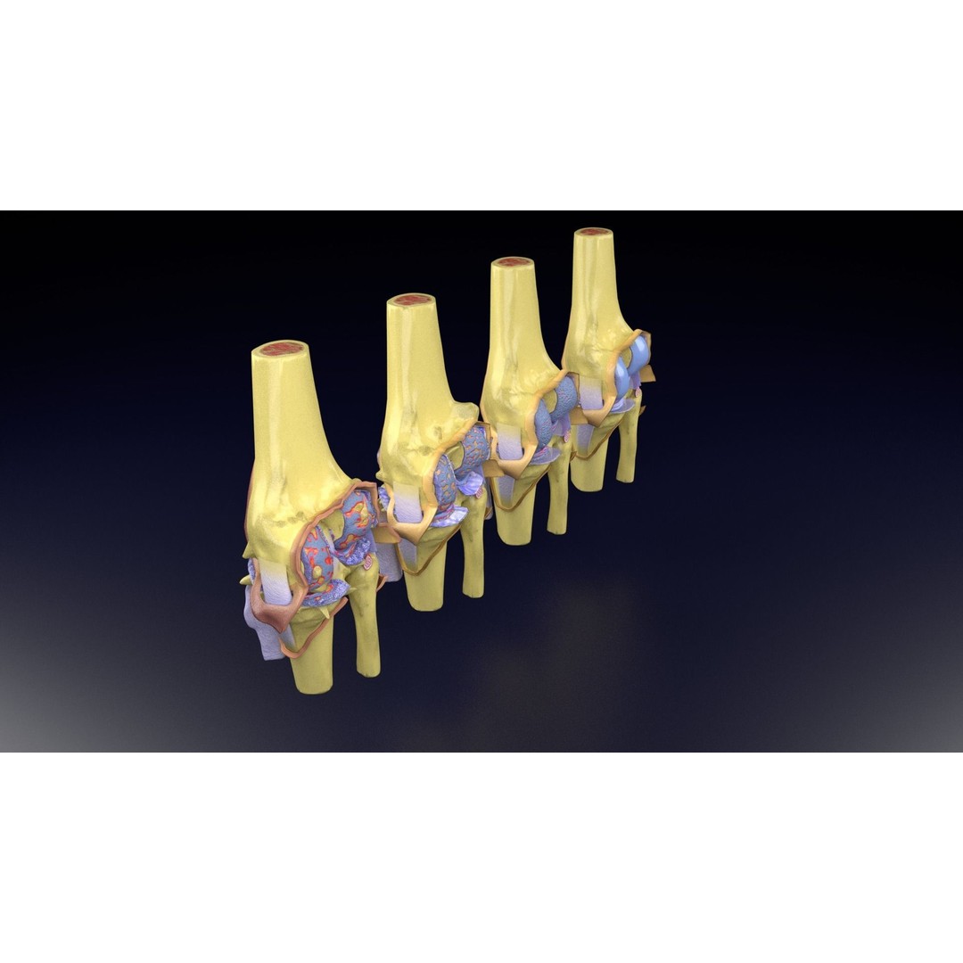 Osteoarthritis 3D Model – Medical Anatomy with Detailed Staging - View 66