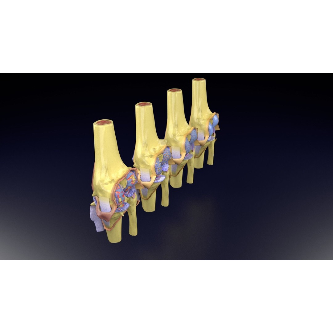 Osteoarthritis 3D Model – Medical Anatomy with Detailed Staging - View 67