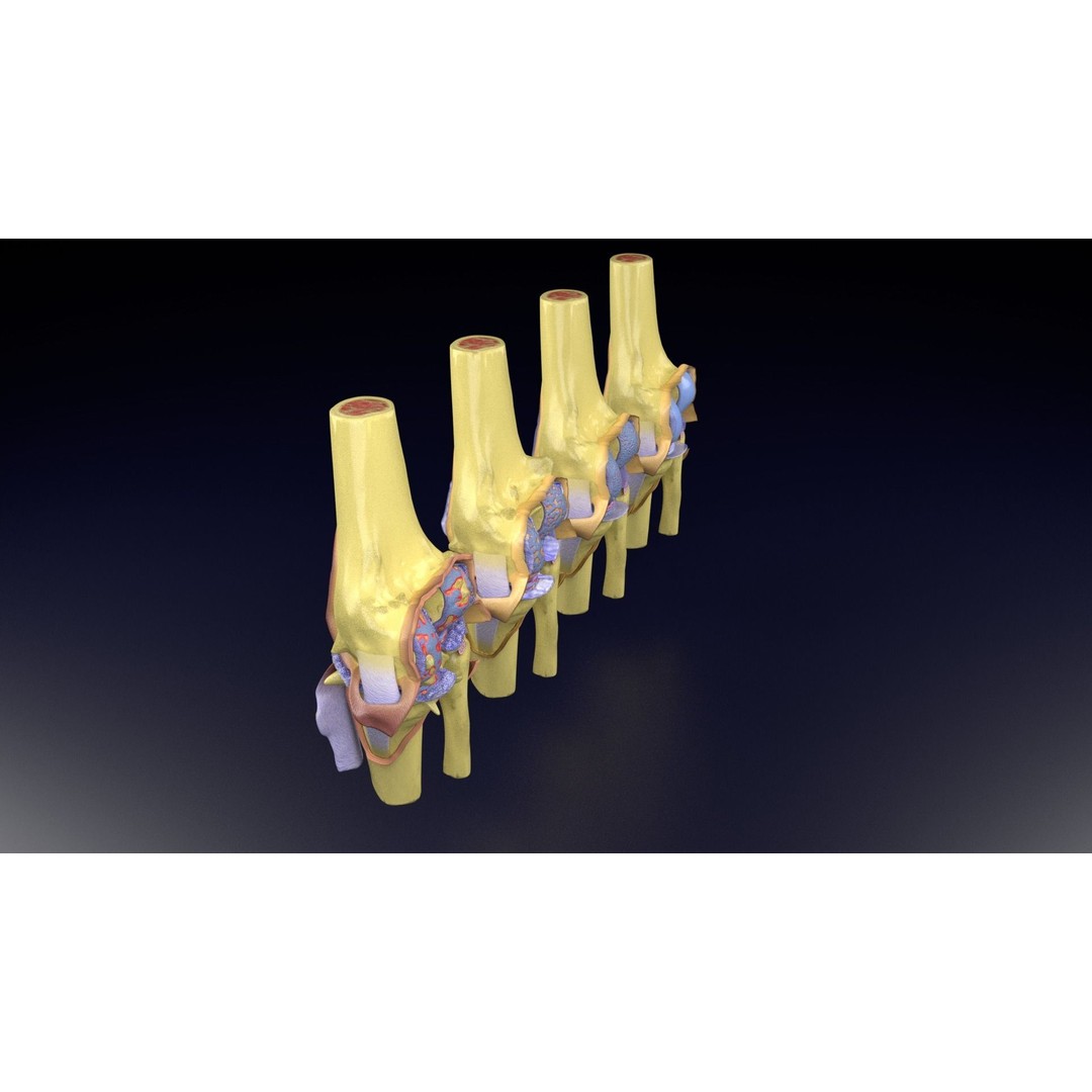 Osteoarthritis 3D Model – Medical Anatomy with Detailed Staging - View 68