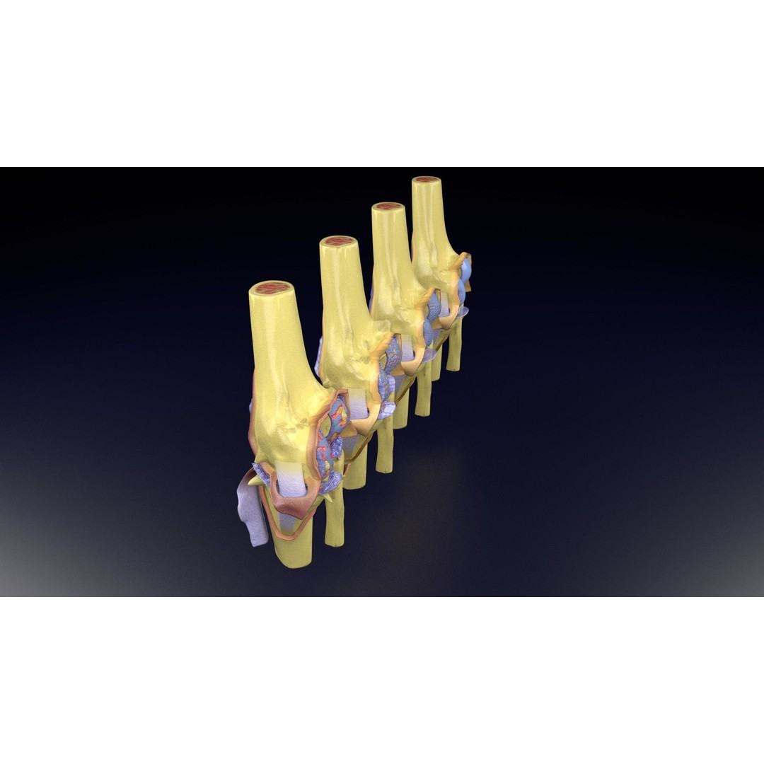 Osteoarthritis 3D Model – Medical Anatomy with Detailed Staging - View 69