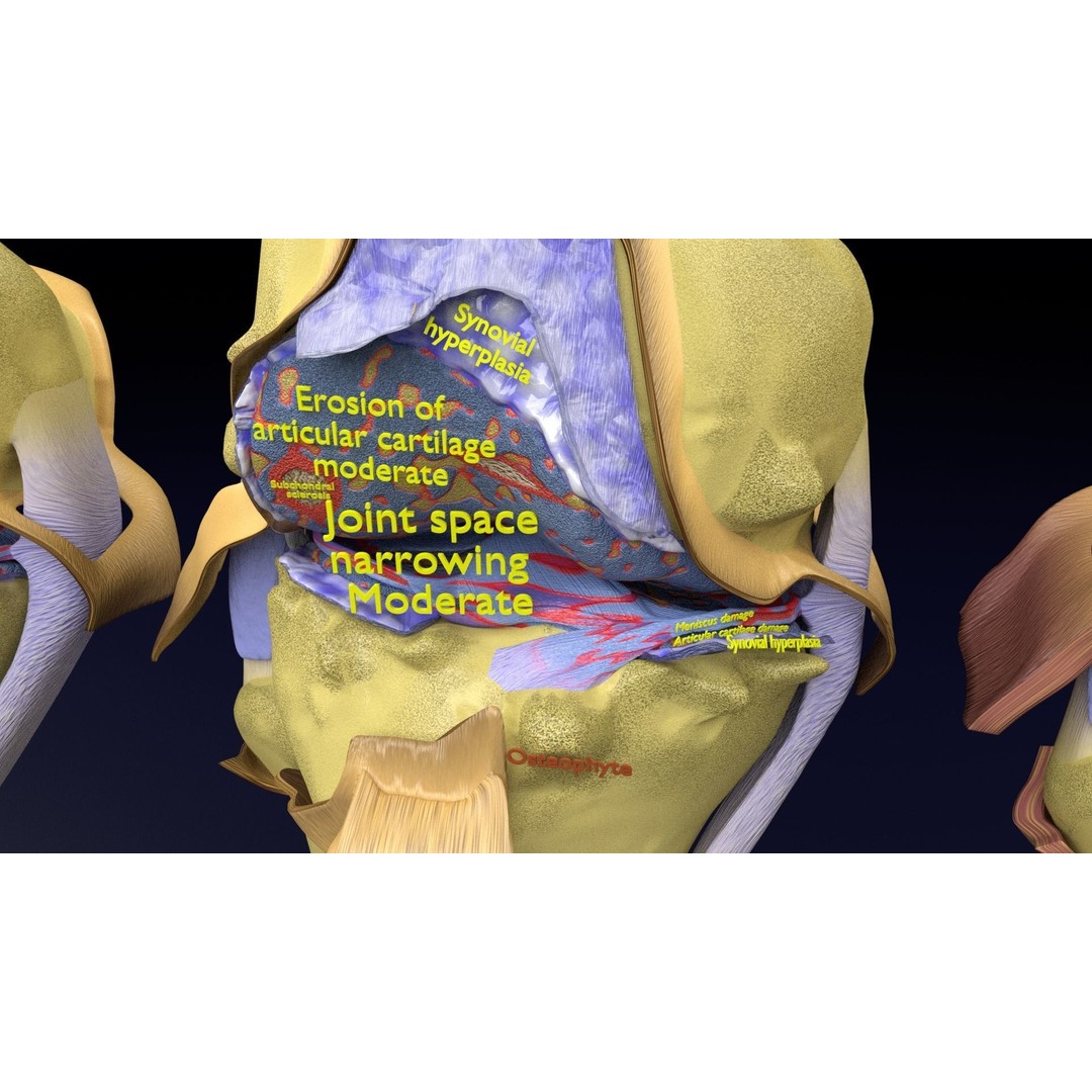 Osteoarthritis 3D Model – Medical Anatomy with Detailed Staging - View 7