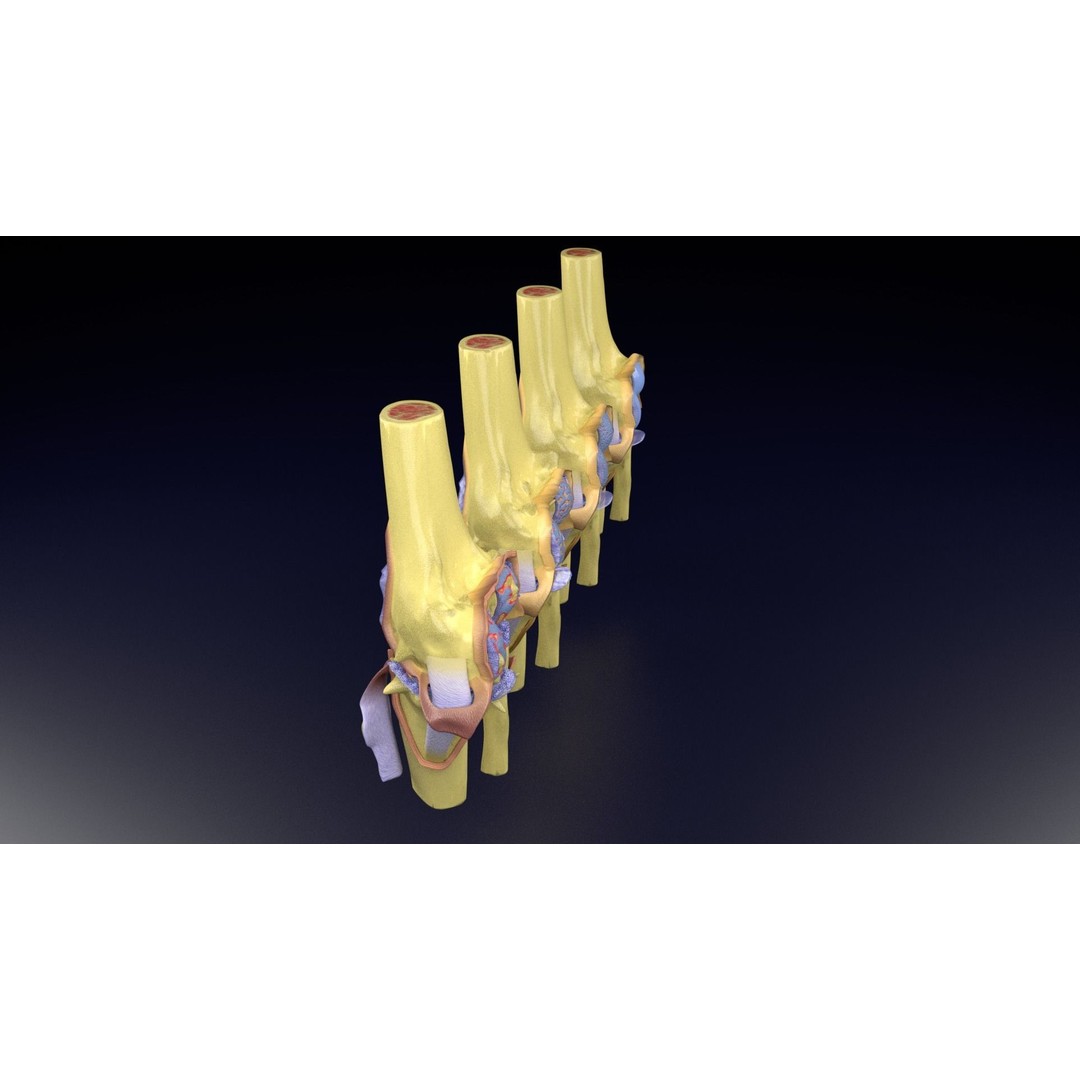 Osteoarthritis 3D Model – Medical Anatomy with Detailed Staging - View 70