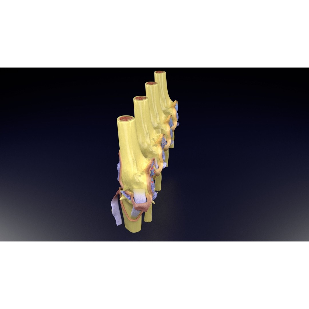 Osteoarthritis 3D Model – Medical Anatomy with Detailed Staging - View 71