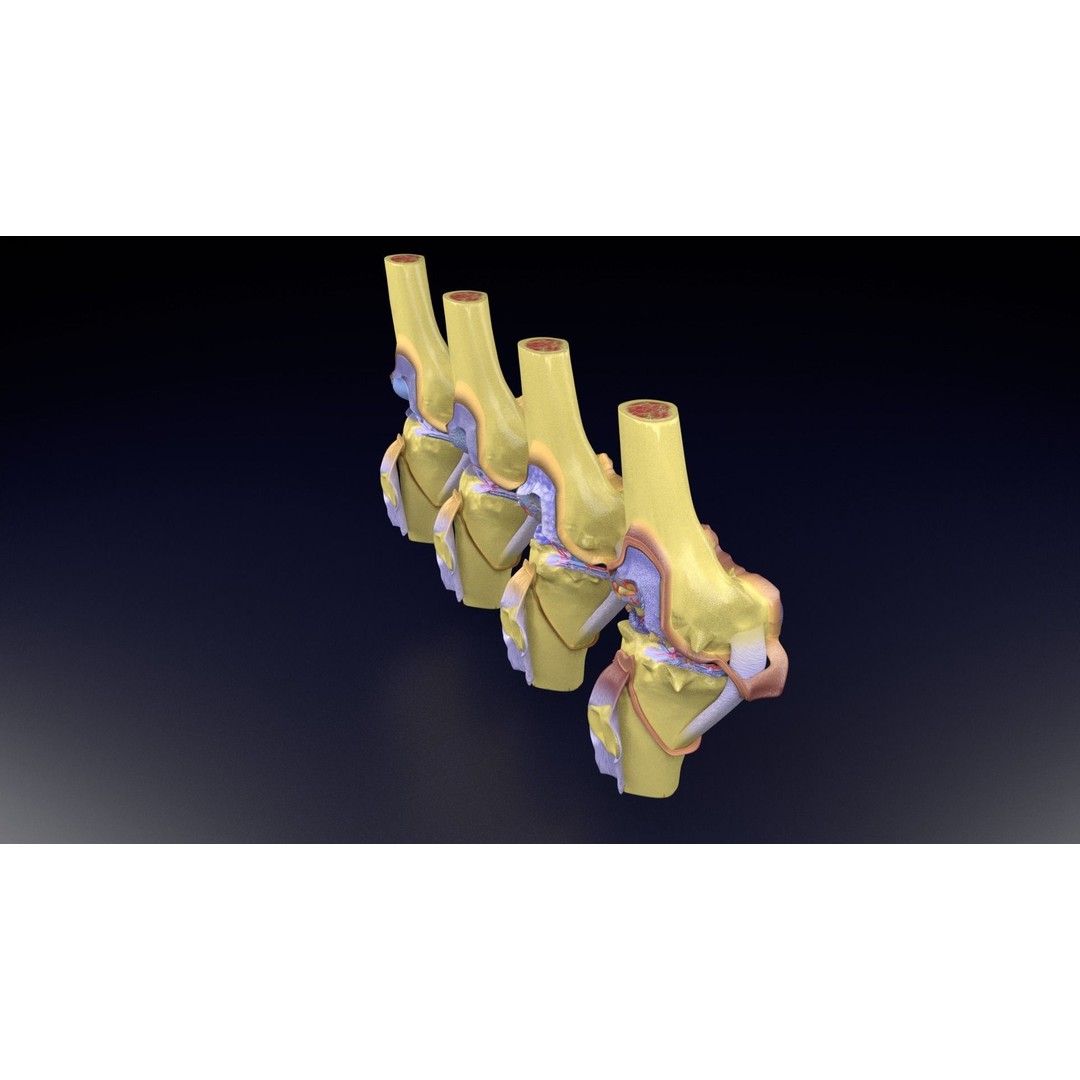 Osteoarthritis 3D Model – Medical Anatomy with Detailed Staging - View 77