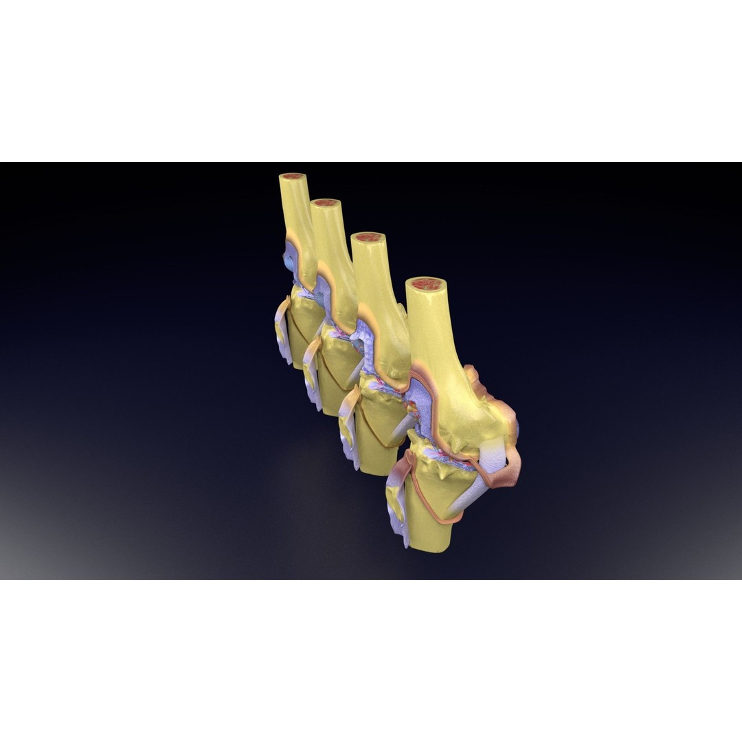 Osteoarthritis 3D Model – Medical Anatomy with Detailed Staging - View 78
