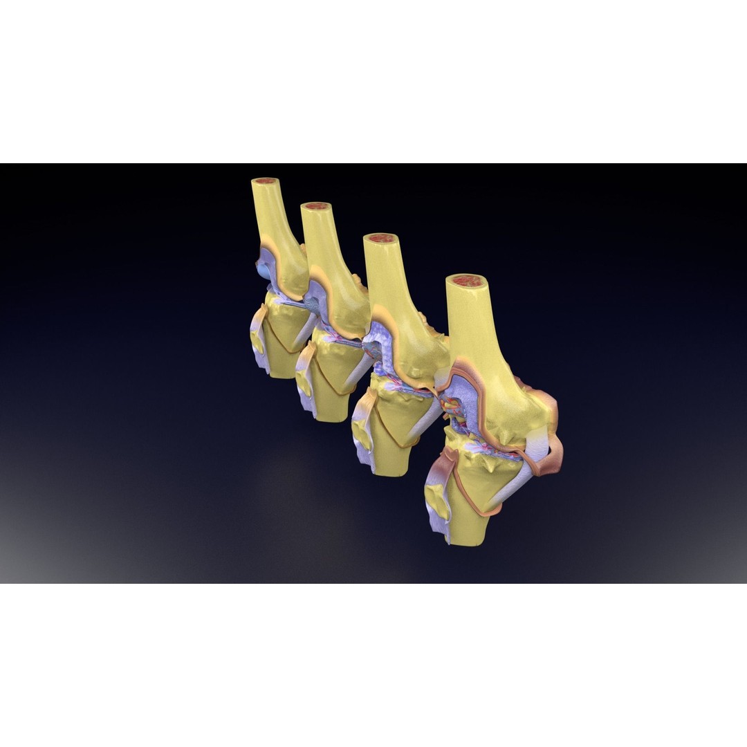 Osteoarthritis 3D Model – Medical Anatomy with Detailed Staging - View 79
