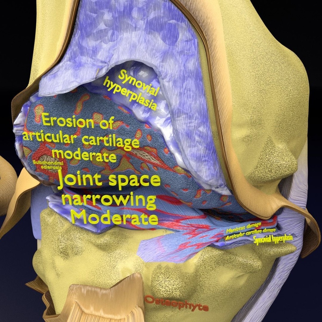 Osteoarthritis 3D Model – Medical Anatomy with Detailed Staging - View 8