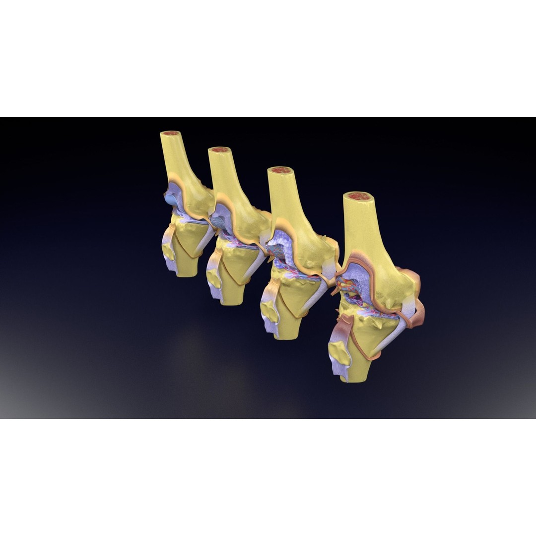 Osteoarthritis 3D Model – Medical Anatomy with Detailed Staging - View 80