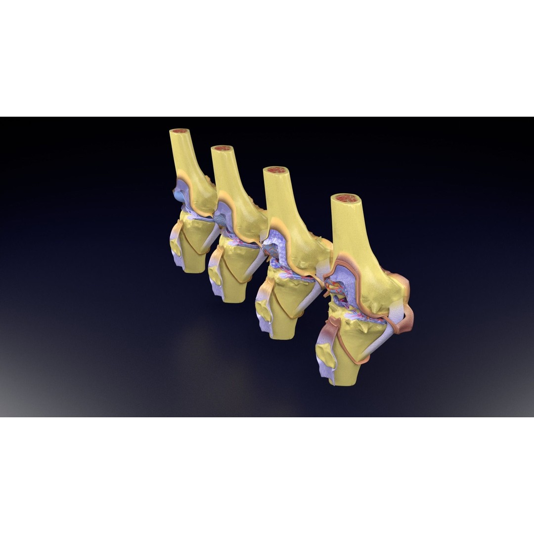Osteoarthritis 3D Model – Medical Anatomy with Detailed Staging - View 81