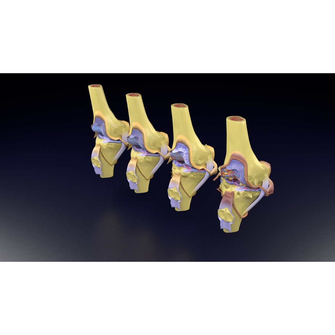 Osteoarthritis 3D Model – Medical Anatomy with Detailed Staging - View 82