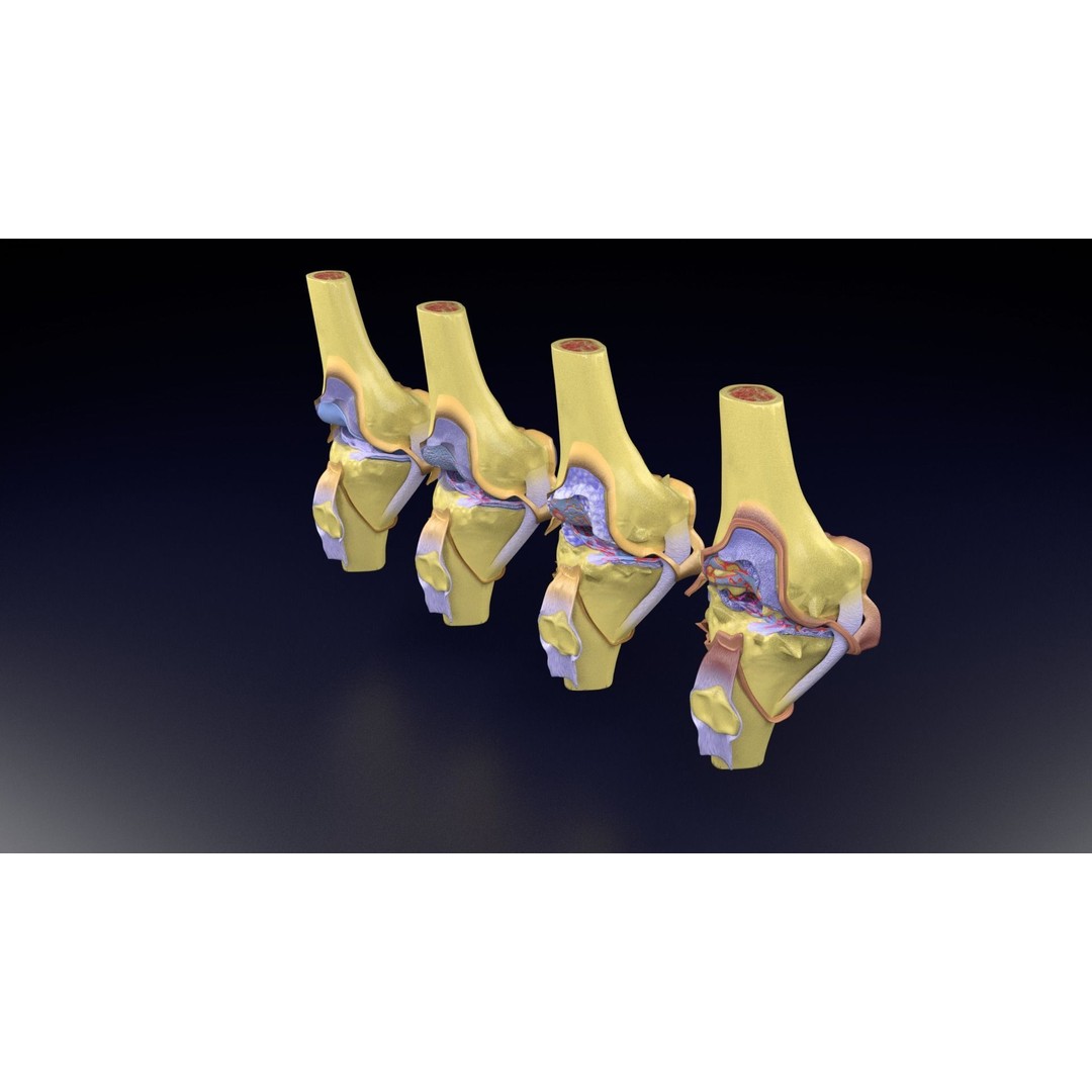 Osteoarthritis 3D Model – Medical Anatomy with Detailed Staging - View 83
