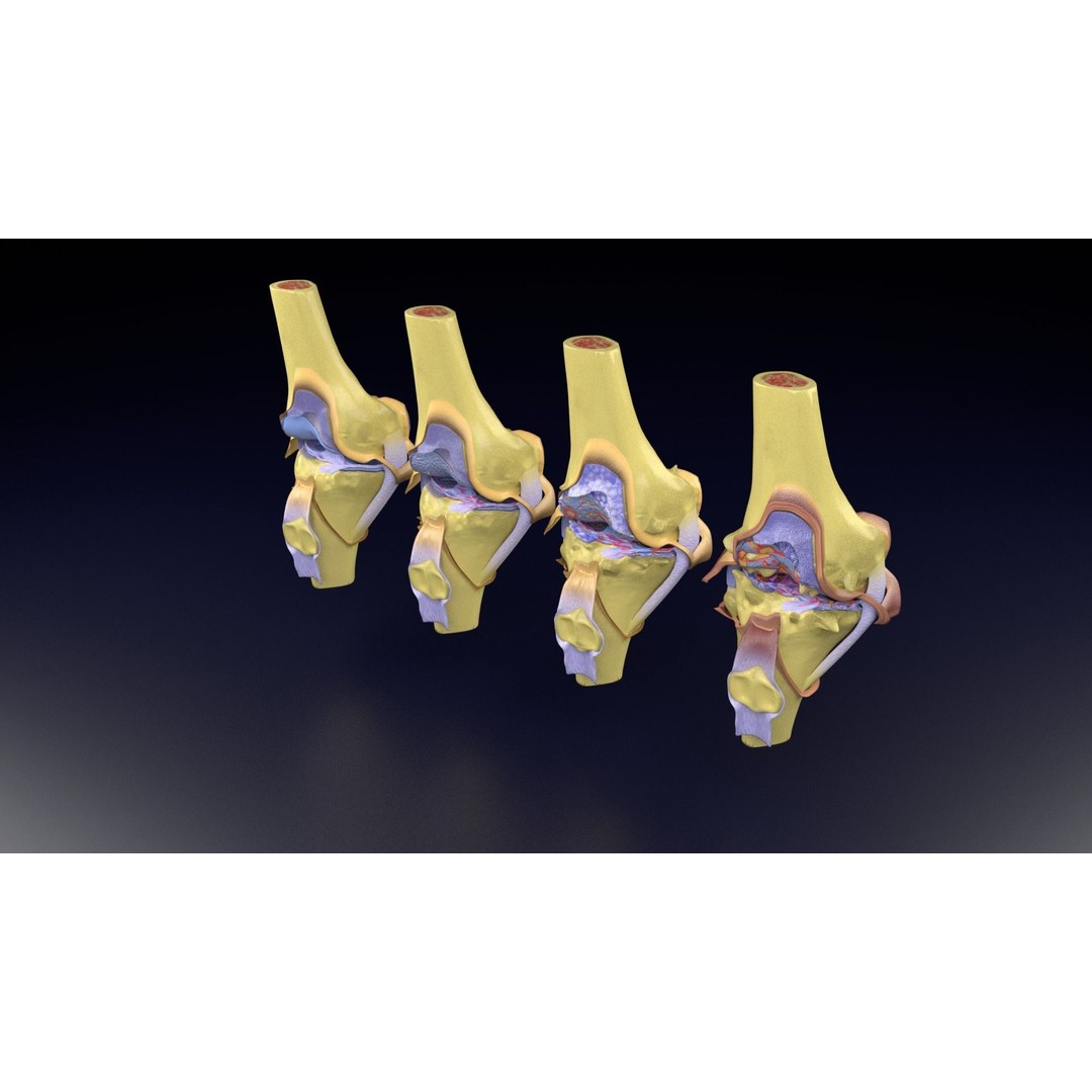 Osteoarthritis 3D Model – Medical Anatomy with Detailed Staging - View 84