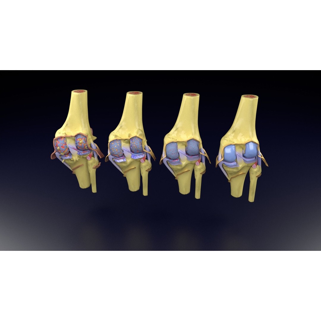Osteoarthritis 3D Model – Medical Anatomy with Detailed Staging - View 85