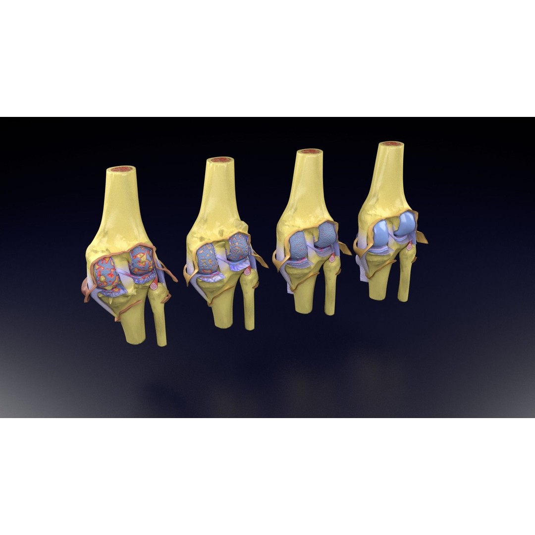 Osteoarthritis 3D Model – Medical Anatomy with Detailed Staging - View 86