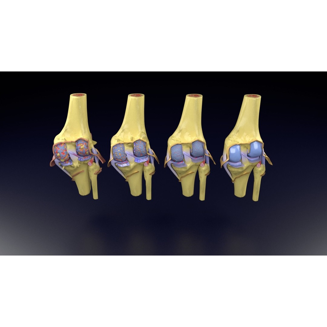 Osteoarthritis 3D Model – Medical Anatomy with Detailed Staging - View 87