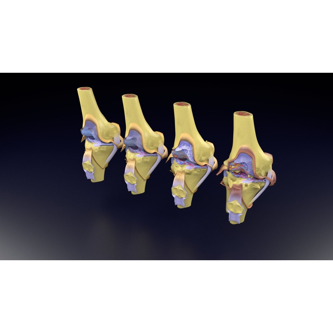 Osteoarthritis 3D Model – Medical Anatomy with Detailed Staging - View 88
