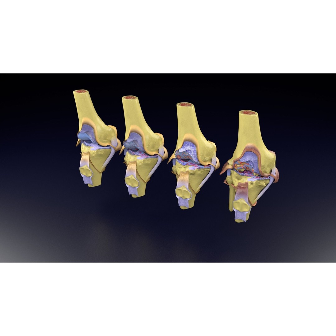 Osteoarthritis 3D Model – Medical Anatomy with Detailed Staging - View 89