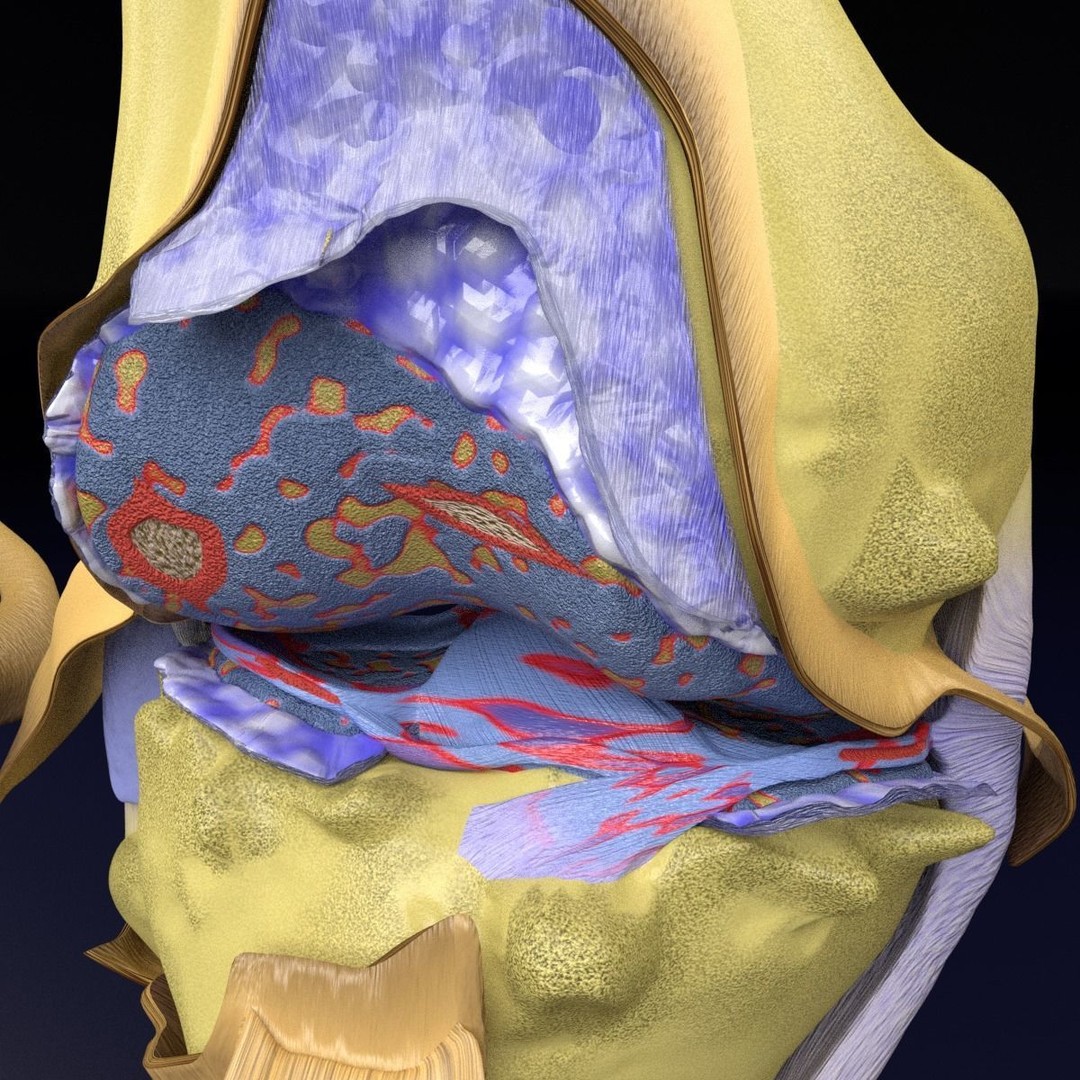 Osteoarthritis 3D Model – Medical Anatomy with Detailed Staging - View 9
