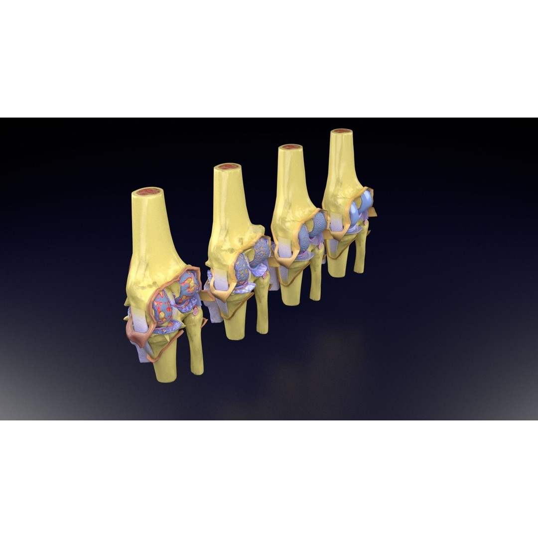 Osteoarthritis 3D Model – Medical Anatomy with Detailed Staging - View 90