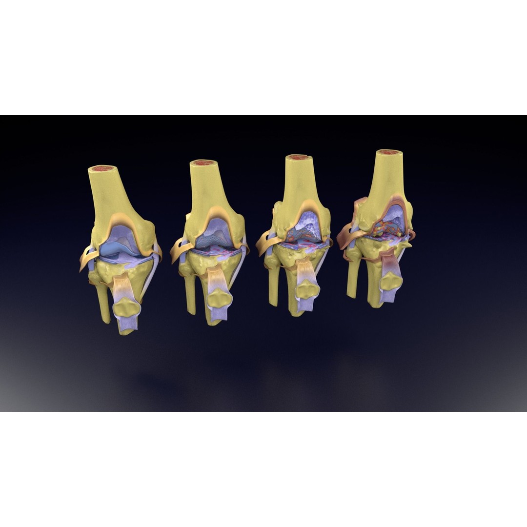 Osteoarthritis 3D Model – Medical Anatomy with Detailed Staging - View 92