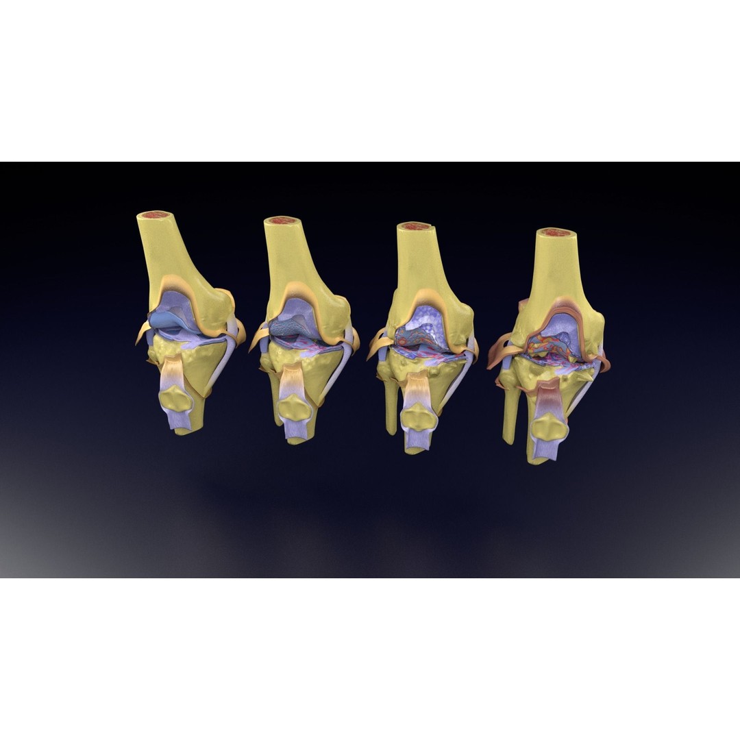 Osteoarthritis 3D Model – Medical Anatomy with Detailed Staging - View 93