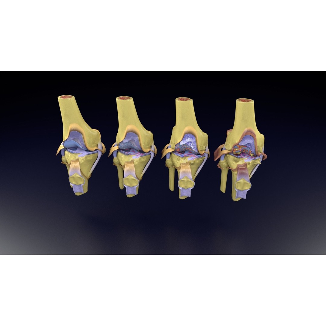 Osteoarthritis 3D Model – Medical Anatomy with Detailed Staging - View 94