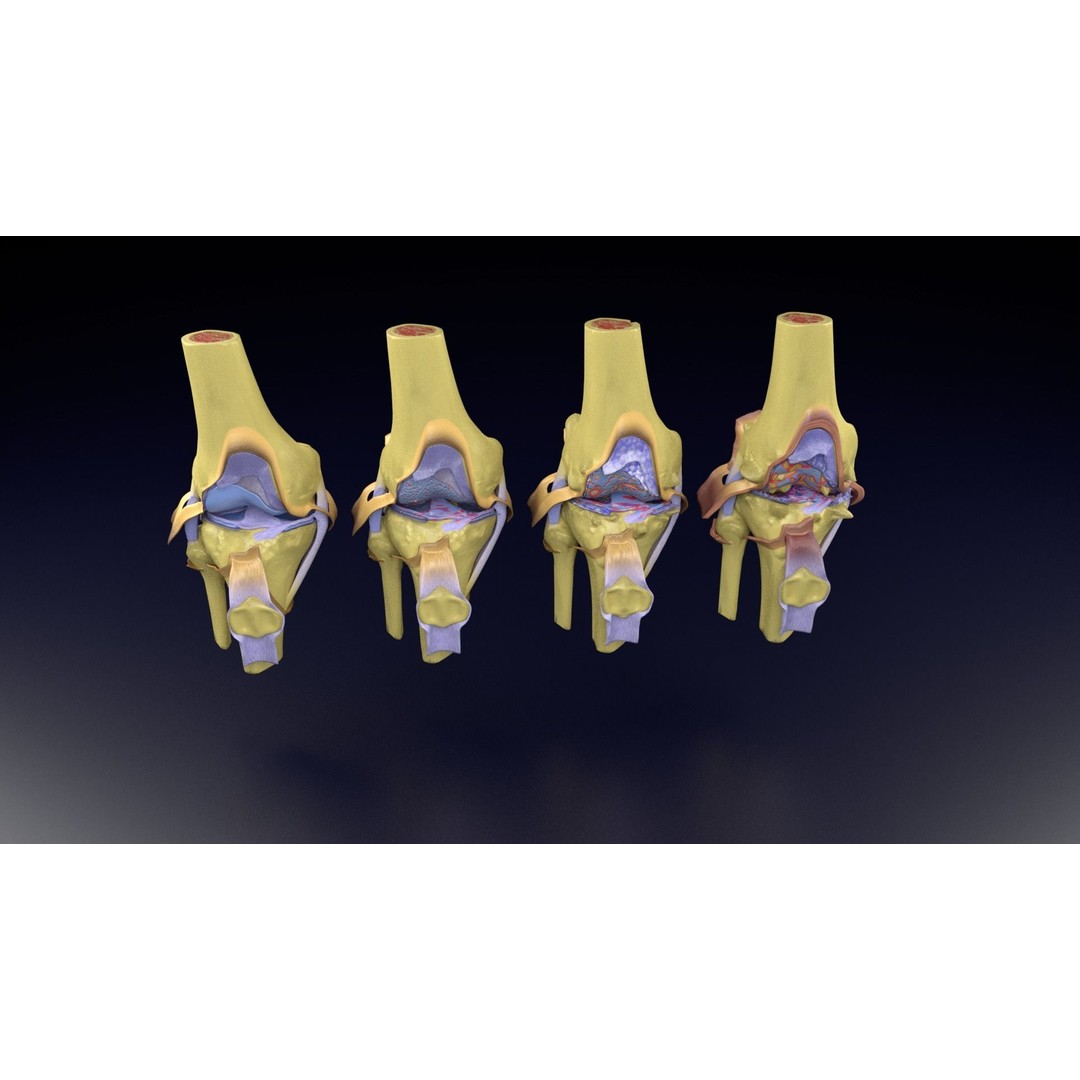 Osteoarthritis 3D Model – Medical Anatomy with Detailed Staging - View 95