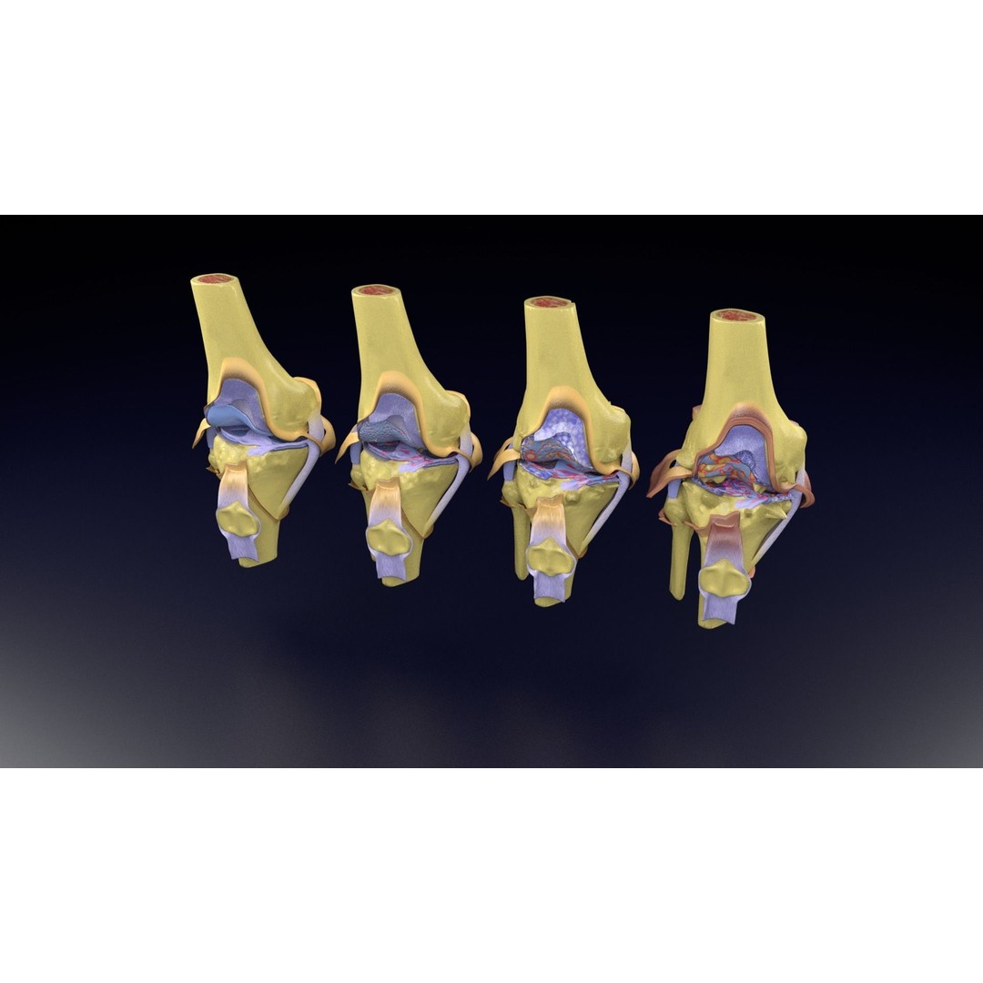 Osteoarthritis 3D Model – Medical Anatomy with Detailed Staging - View 96
