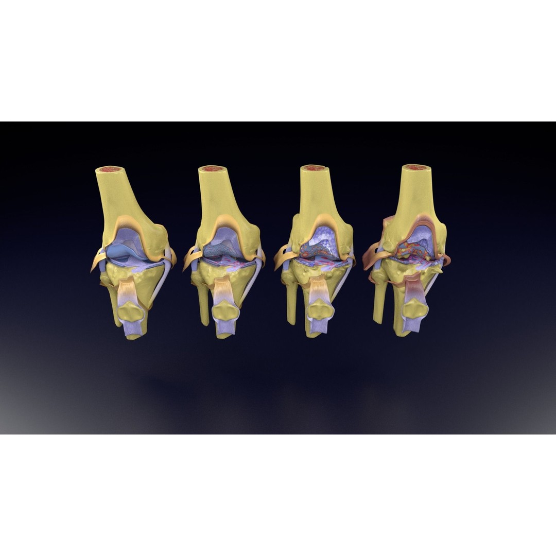 Osteoarthritis 3D Model – Medical Anatomy with Detailed Staging - View 97