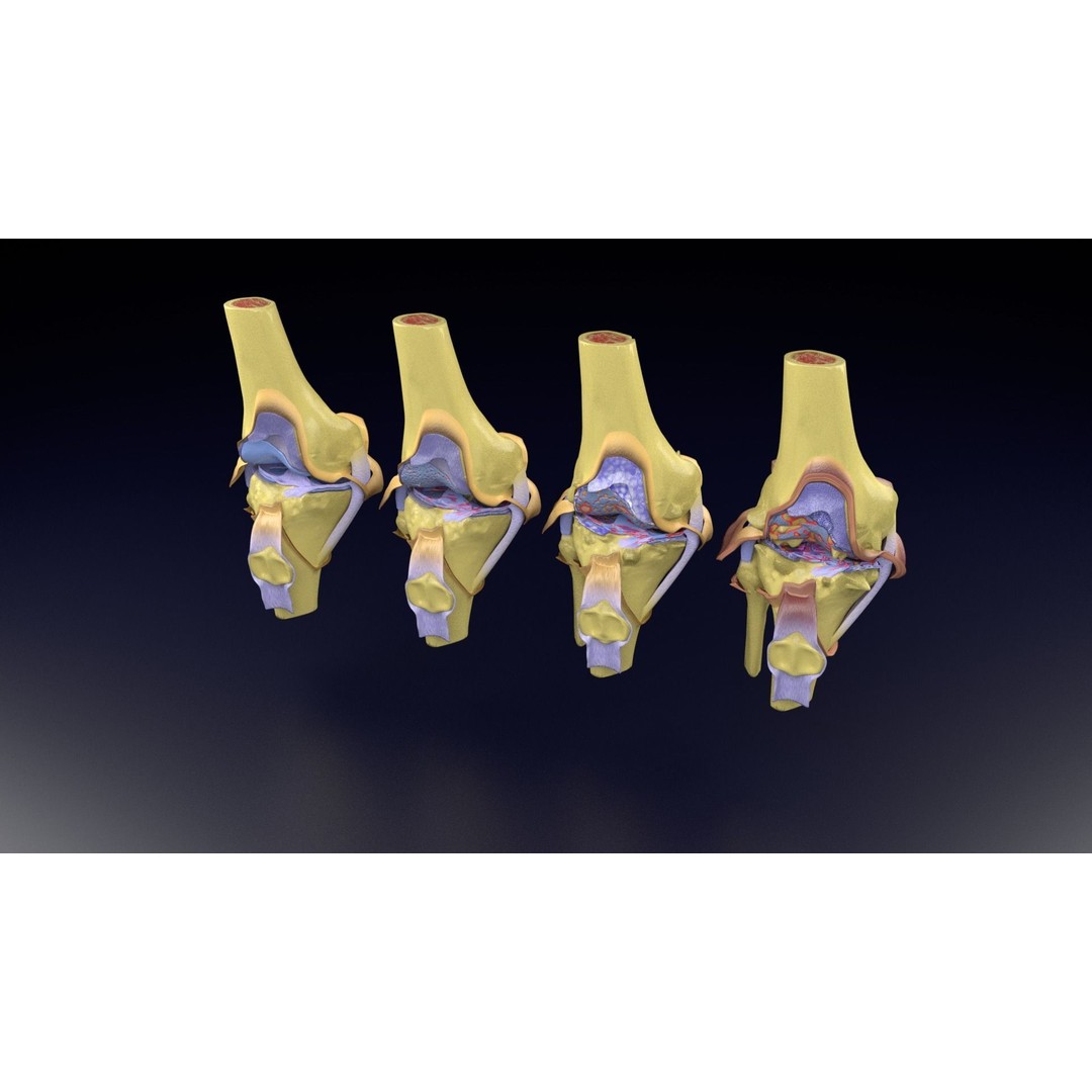 Osteoarthritis 3D Model – Medical Anatomy with Detailed Staging - View 98