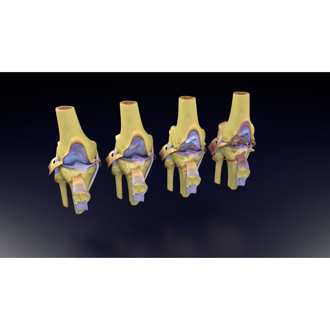 Osteoarthritis 3D Model – Medical Anatomy with Detailed Staging - View 99
