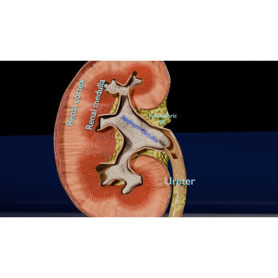 Kidney Stone 3D Model – Low Poly Medical Asset, PBR Textures, FBX - View 3