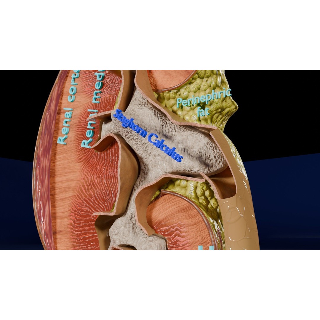 Kidney Stone 3D Model – Low Poly Medical Asset, PBR Textures, FBX - View 4