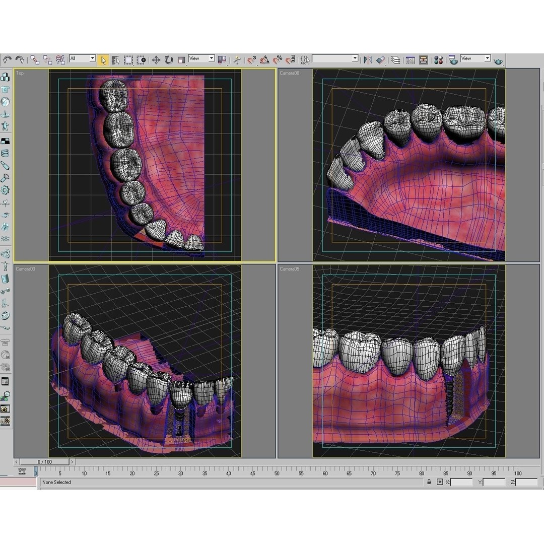 Dental Implant 3D Model – PBR Animated Medical Asset, FBX & OBJ
