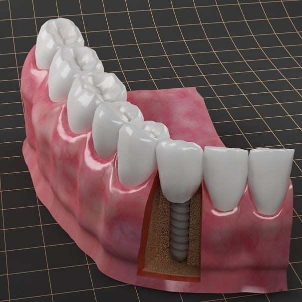 Dental Implant 3D Model – PBR Animated Medical Asset, FBX & OBJ - View 11