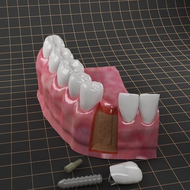 Dental Implant 3D Model – PBR Animated Medical Asset, FBX & OBJ - View 12