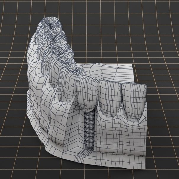 Dental Implant 3D Model – PBR Animated Medical Asset, FBX & OBJ - View 13