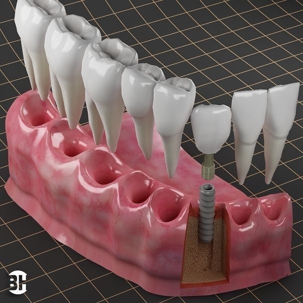 Dental Implant 3D Model – PBR Animated Medical Asset, FBX & OBJ - View 14