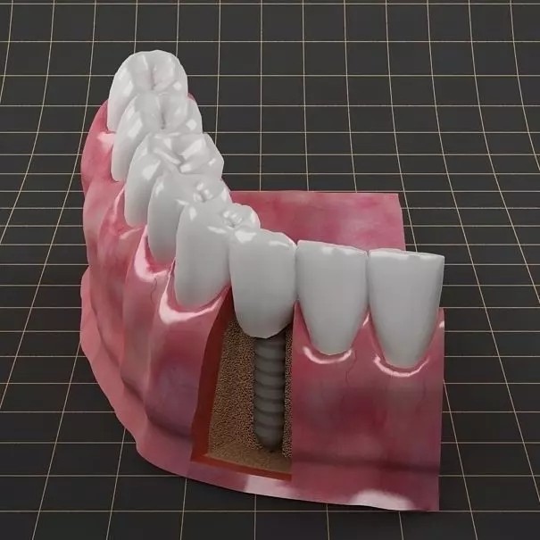 Dental Implant 3D Model – PBR Animated Medical Asset, FBX & OBJ - View 2