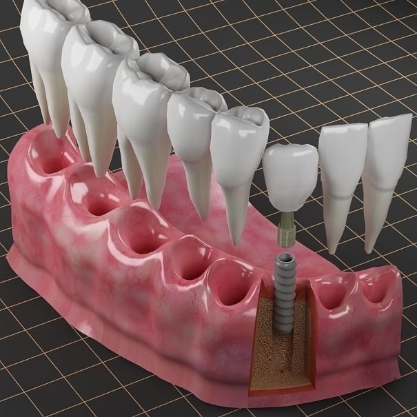 Dental Implant 3D Model – PBR Animated Medical Asset, FBX & OBJ - View 3