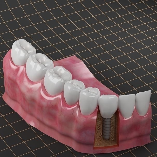Dental Implant 3D Model – PBR Animated Medical Asset, FBX & OBJ - View 4