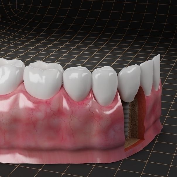 Dental Implant 3D Model – PBR Animated Medical Asset, FBX & OBJ - View 6