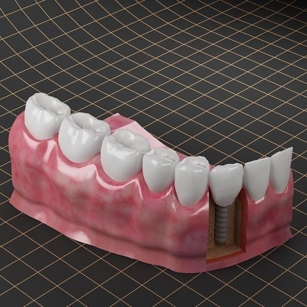 Dental Implant 3D Model – PBR Animated Medical Asset, FBX & OBJ - View 7