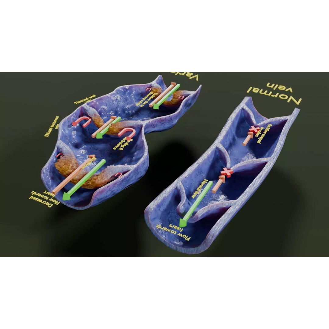 Varicose Vein Valve 3D Model – Low Poly Medical Asset, PBR Textures - View 15