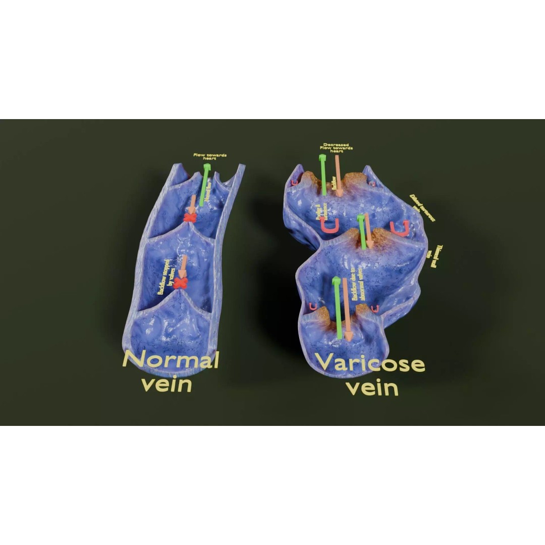 Varicose Vein Valve 3D Model – Low Poly Medical Asset, PBR Textures - View 16