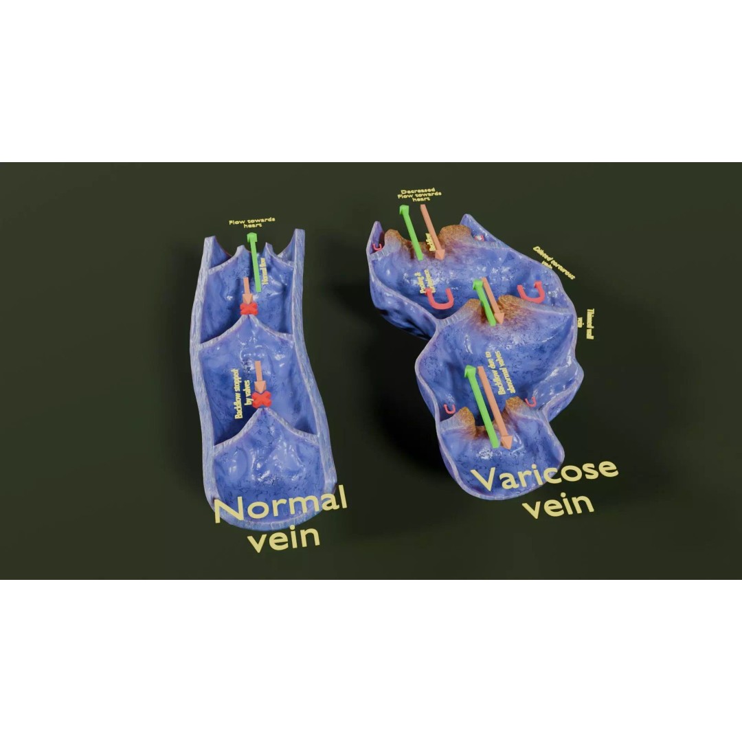 Varicose Vein Valve 3D Model – Low Poly Medical Asset, PBR Textures - View 17